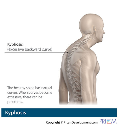 kyphosis
