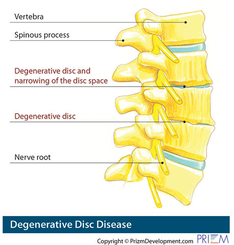 degenerative disc disease treatment